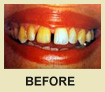 Before cosmetic dental treatment